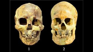 Two side-by-side skulls with missing teeth.