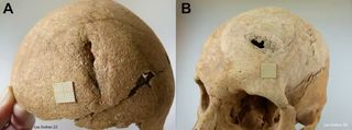 A close-up of a skull with holes in the front and back of the head